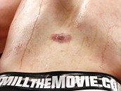 Ringworm: How to Prevent Every Athletes Worst Enemy